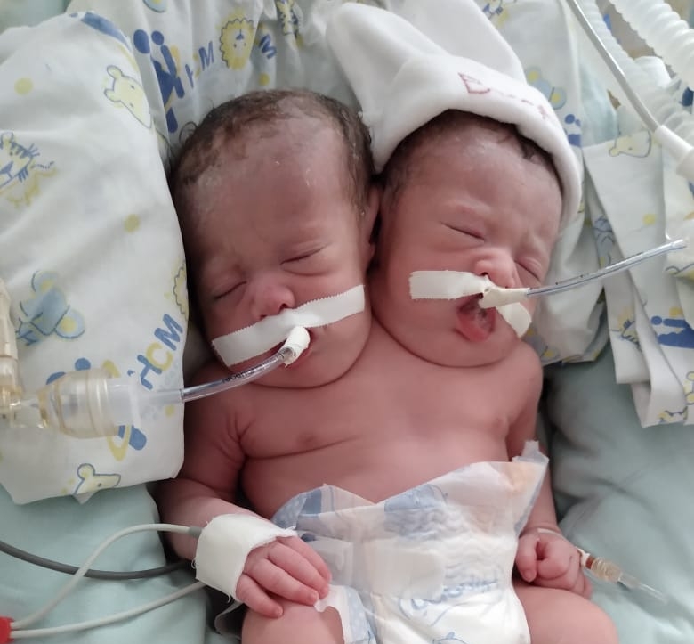 Resultado de imagem para BebÃª com duas cabeÃ§as nasce no interior de SÃ£o Paulo